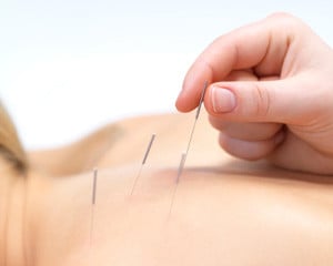 Acupuncture